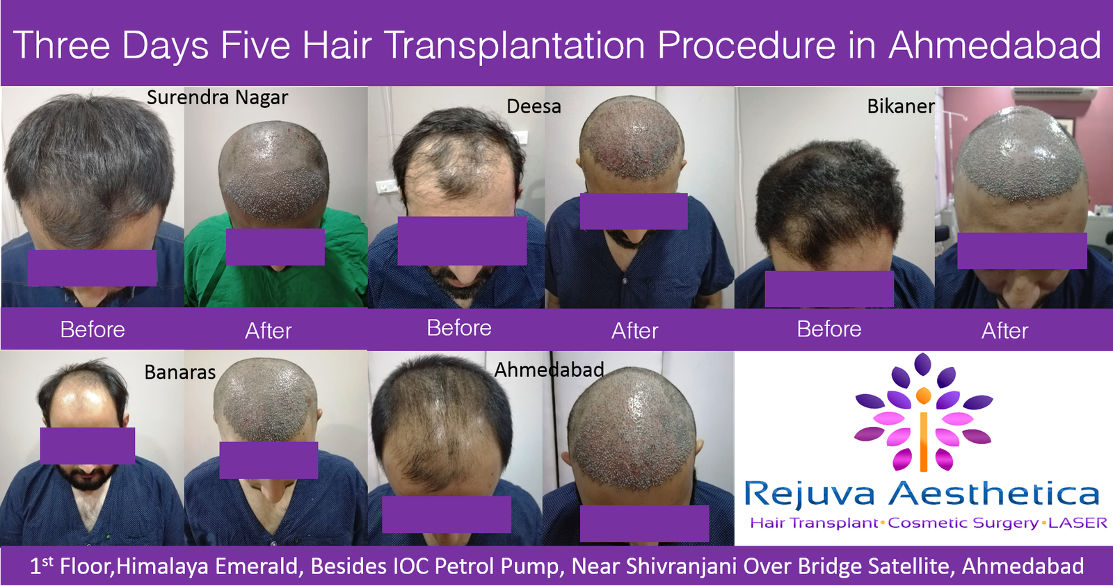 2 days 5 Hair Transplant procedures