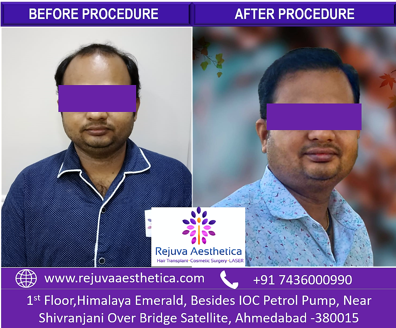 Hair Transplant in Ahmedabad