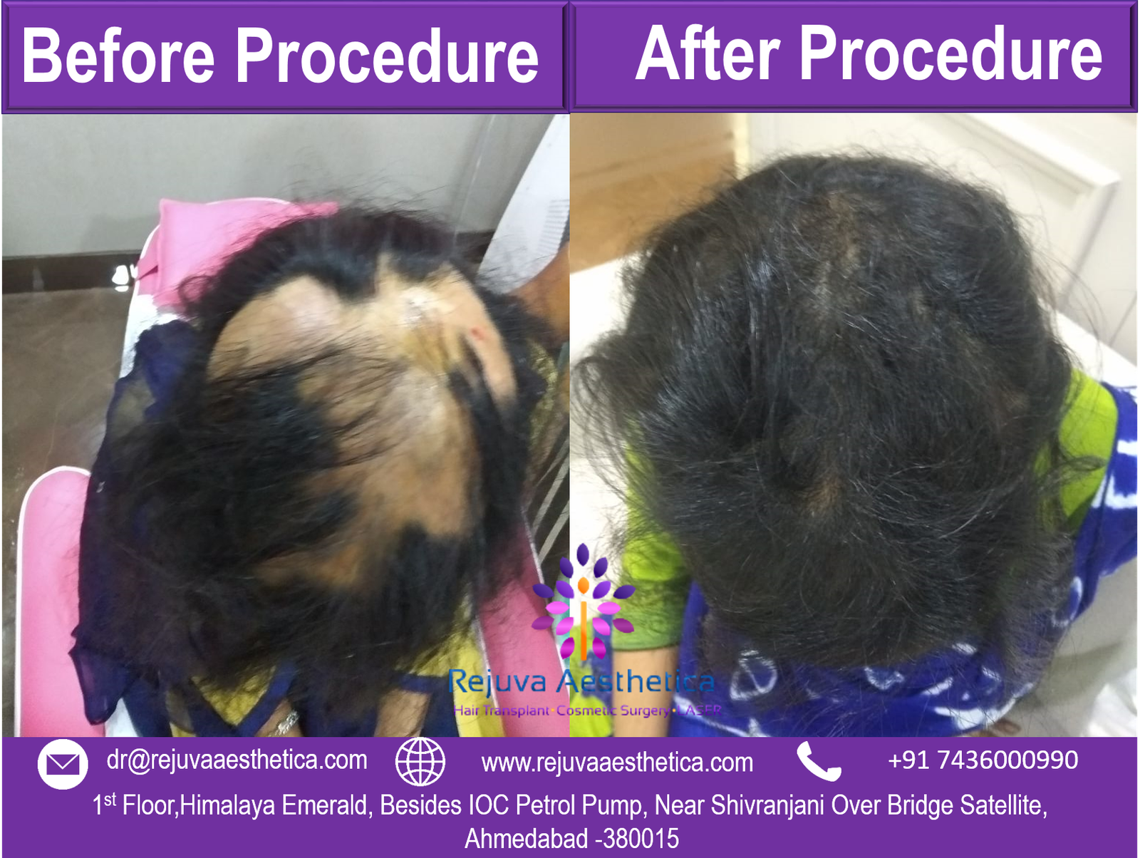 before after alopecia treatment