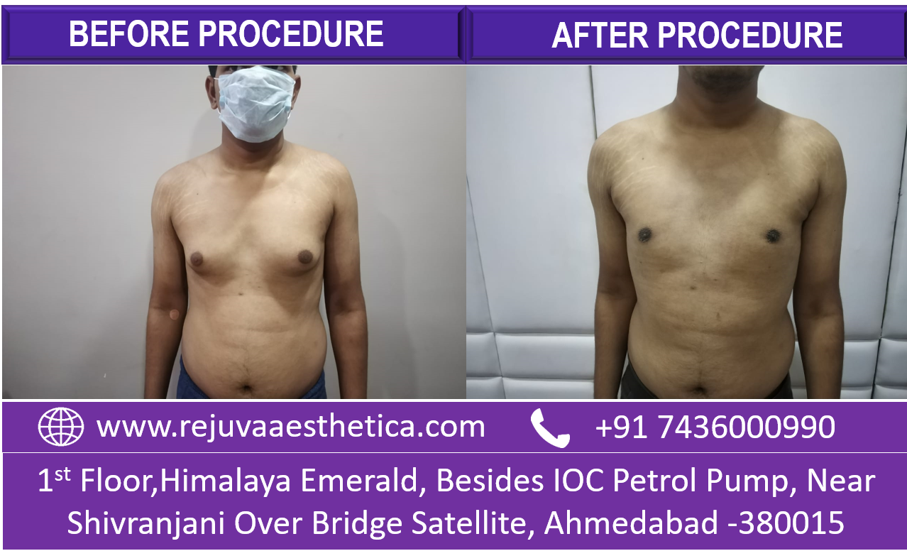 gynecomastia Treatment in Ahmedabad