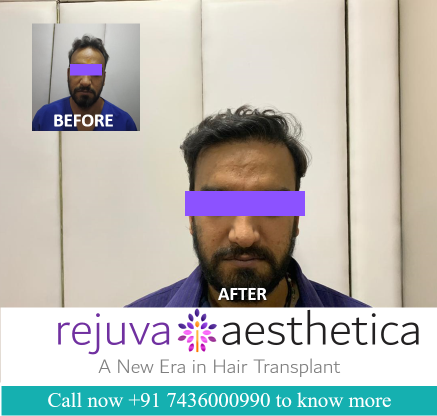 Hair Transplant Price in Ahmedabad,Gujarat Hair Transplant Price in Ahmedabad,Gujarat