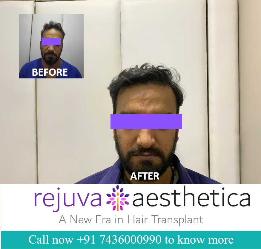 hair transplant vadodara Gujarat  Rejuva Aesthetica