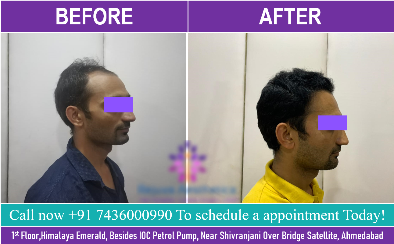 Best Hair Transplant in India