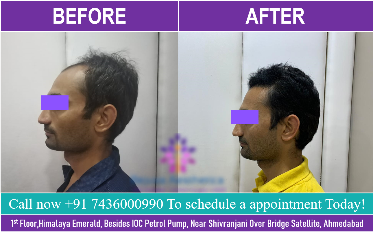 Hair Transplant Doctor in Ahmedabad,Gujarat