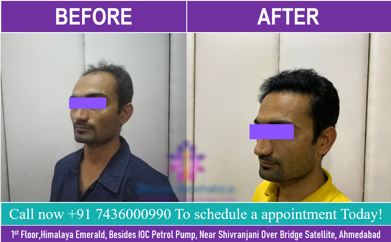 Best Hair Transplant Results in Ahmedabad,Guajrat