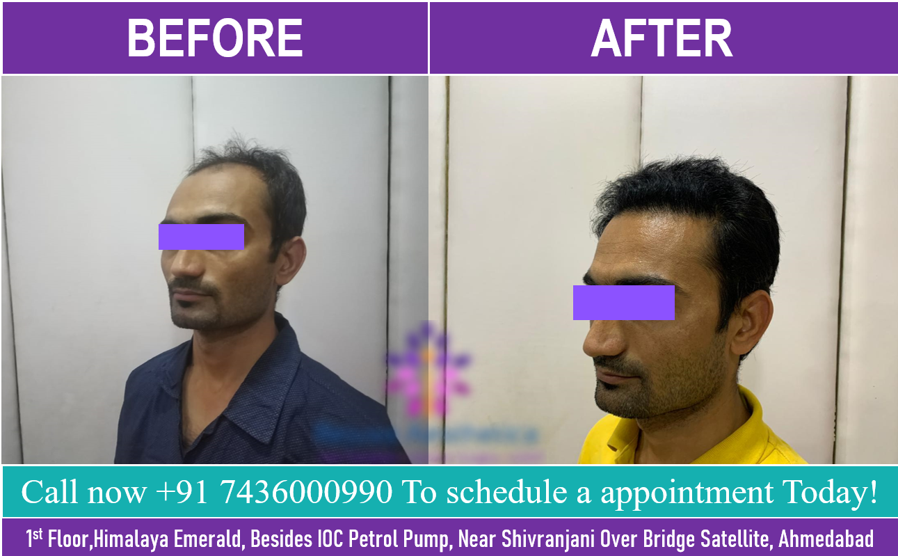 Dr Batras Hair loss Treatment Transplant Offers Coupons Regrowth Price