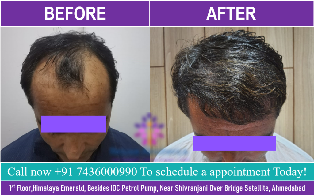 Hair Transplant in Ahmedabad,Gujarat | Rejuva Aesthetica Hair Transplant in Ahmedabad,Gujarat | Rejuva Aesthetica