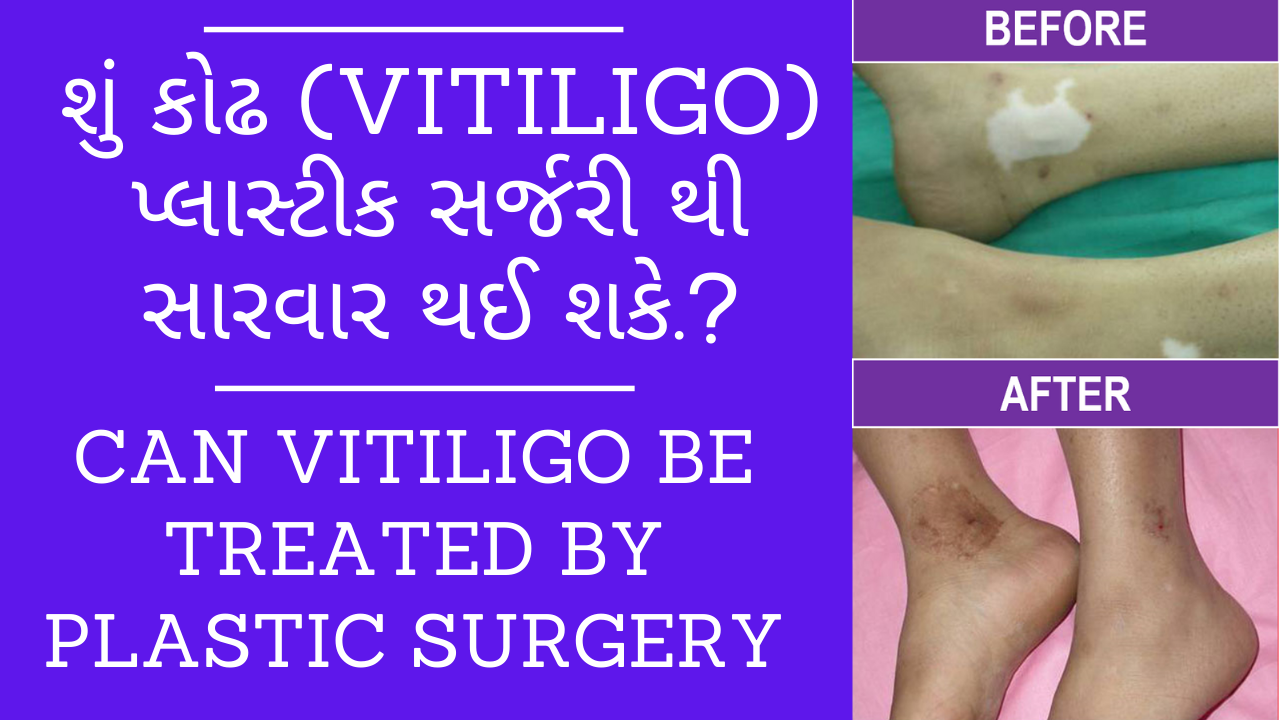 Can Vitiligo be Treated by Plastic Surgery explained by plastic surgeon in India