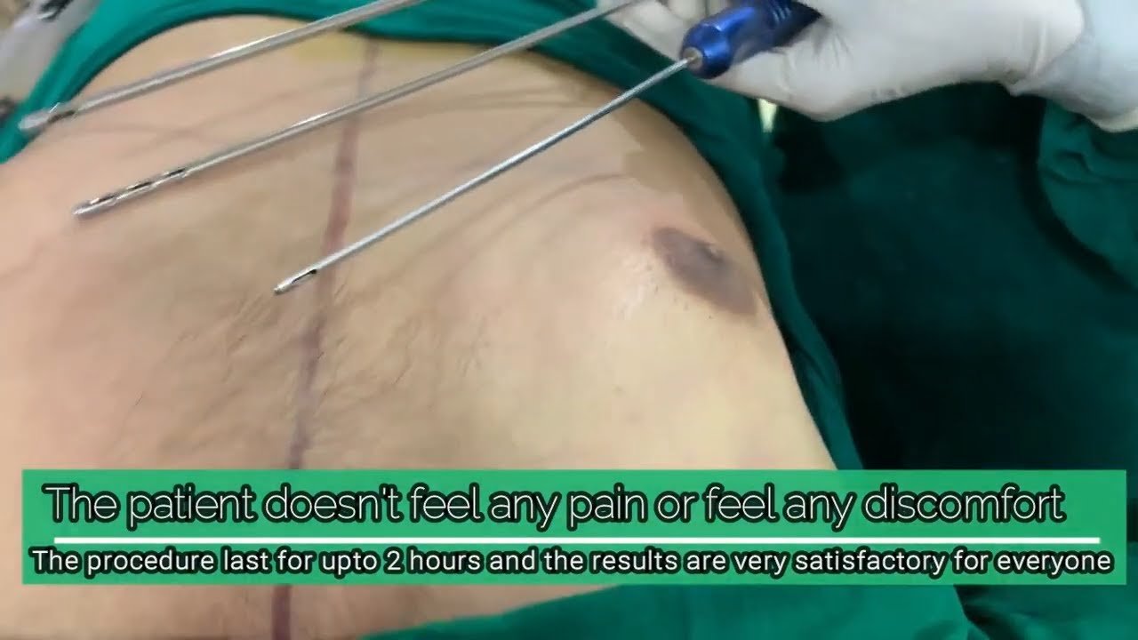 Liposuction Treatment in Ahmedabad, Gujarat