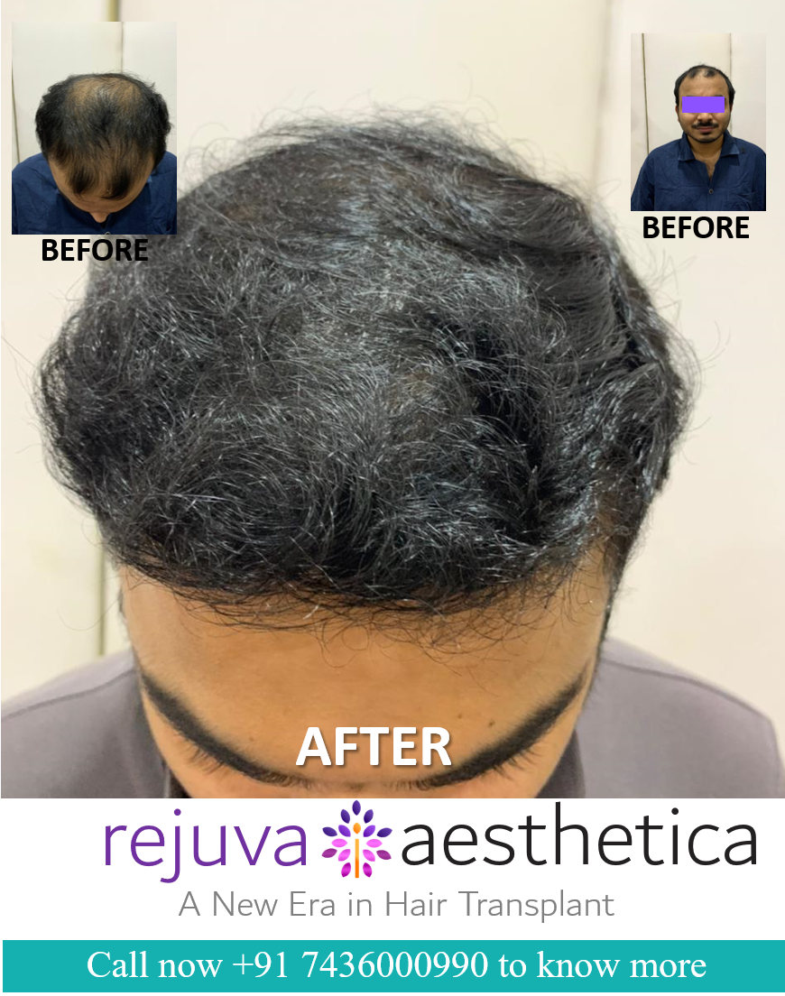 Hair Transplant in India