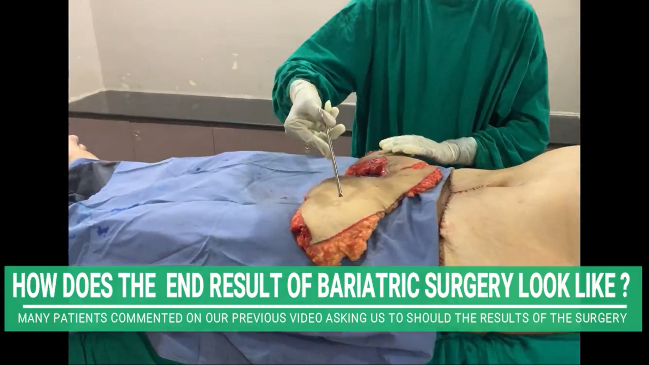 End results of Post Bariatric Tummy Tuck Surgery (Abdominoplasty) in India by Plastic Surgeon