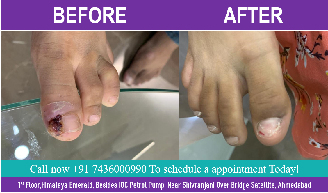 Doctors for Nail infection in Ahmedabad | Rejuva Aesthetica