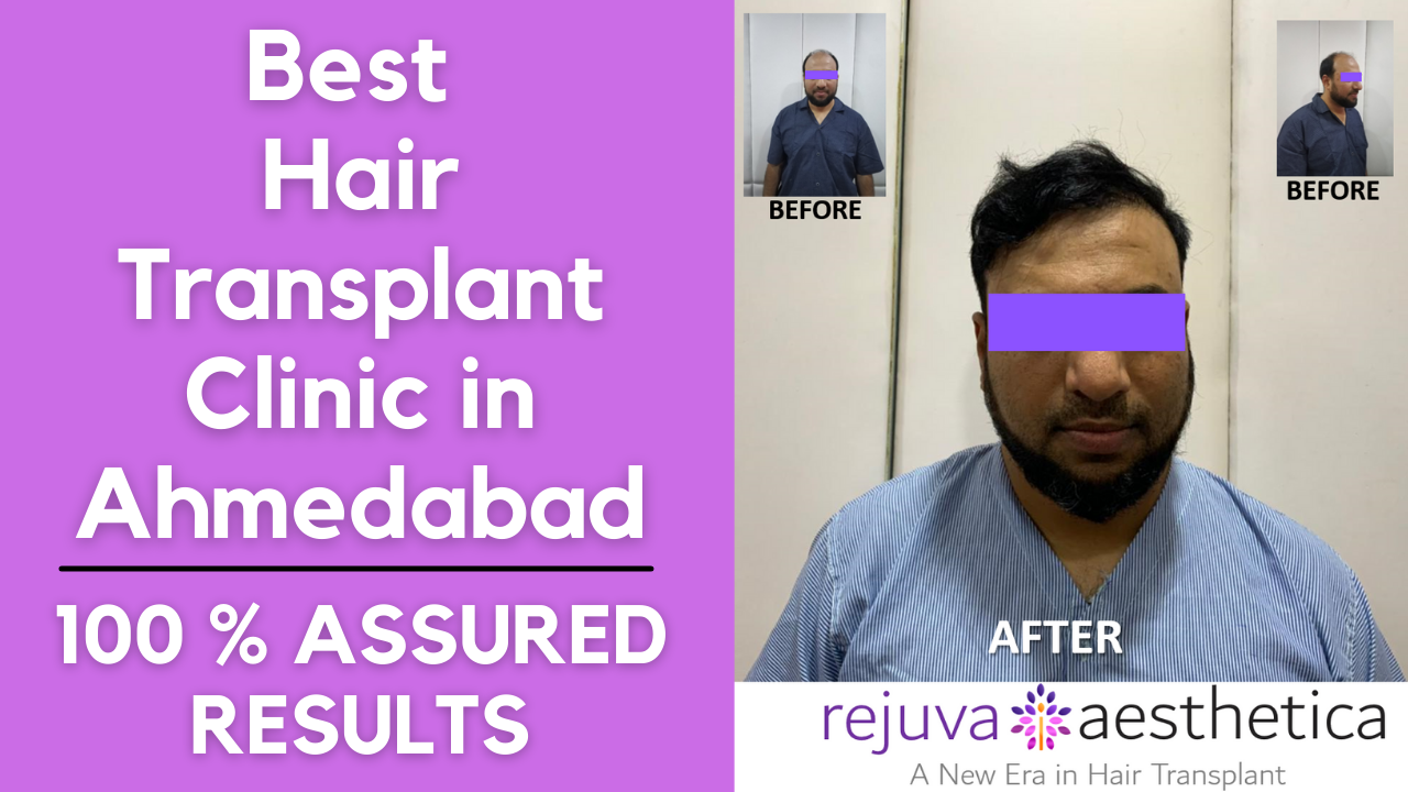 NRI from USA came to Ahmedabad for his Hair Transplantation done by Dr. Arth Shah