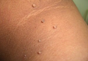 Skin Tag removal Treatment in Gandhinagar