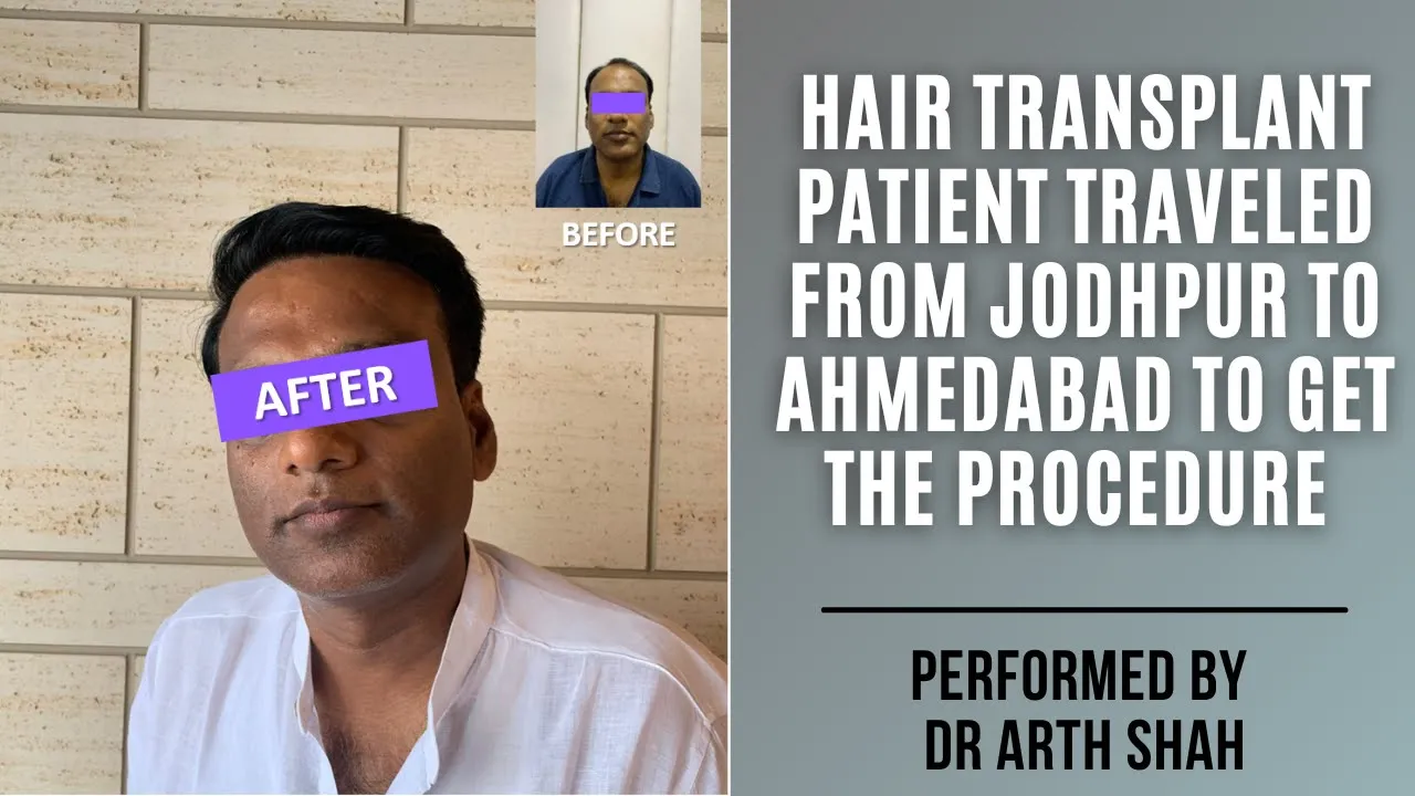Hair Transplant in Ahmedabad